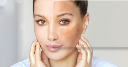 Melasma: dicas de prevenção e tratamentos