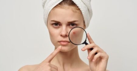 Prevenir e tratar acne